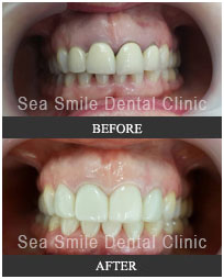  Dental veneer