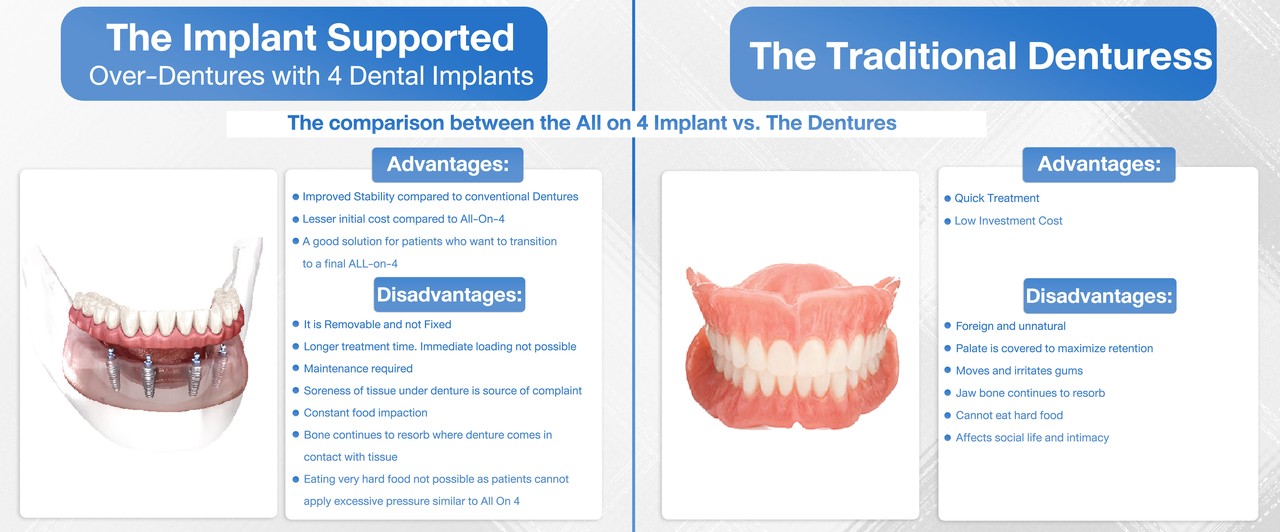 The Impression of patients for Bangkok Smile All-On-4™