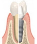 Dental Implant