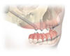 Dental Implant