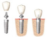 Dental Implant