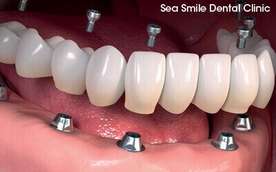 multiple dental implants