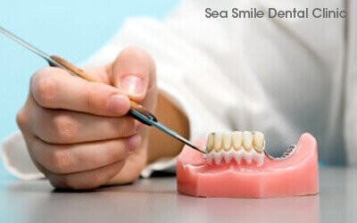 removable dentures