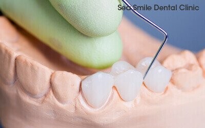 dental bridge