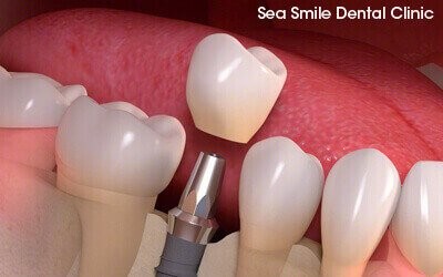 single-tooth implant