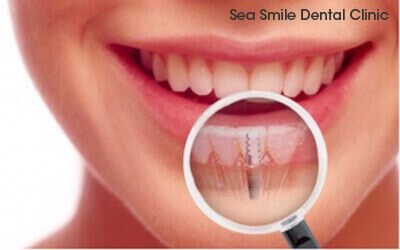 dental implants