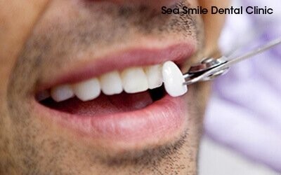 dental veneers