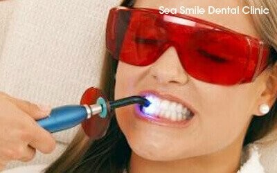 laser teeth whitening