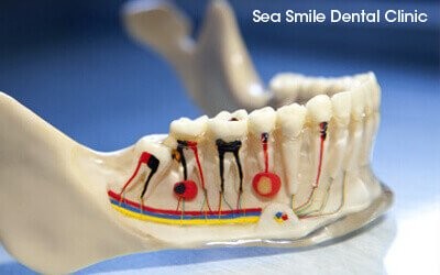 root canal treatment