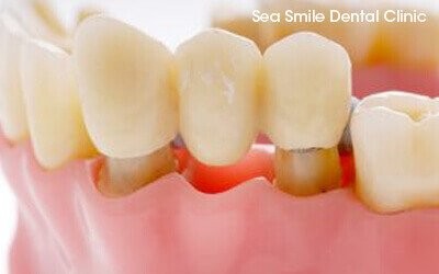 dental crowns