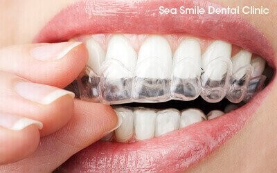 invisalign® orthodontics