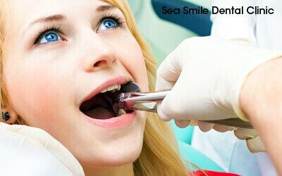 tooth extraction