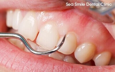 gum treatment/periodontics