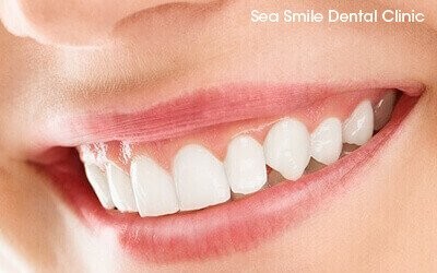 dental veneers