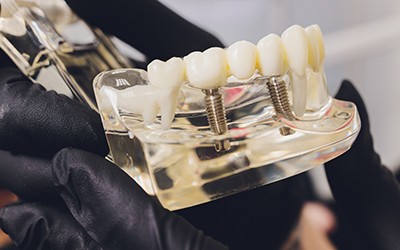 multiple dental implants