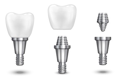 immediate-loading implants