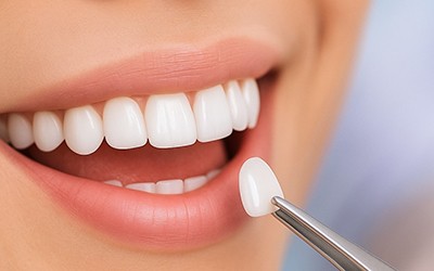 dental veneers