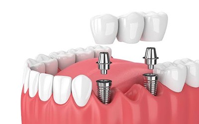 dental implants