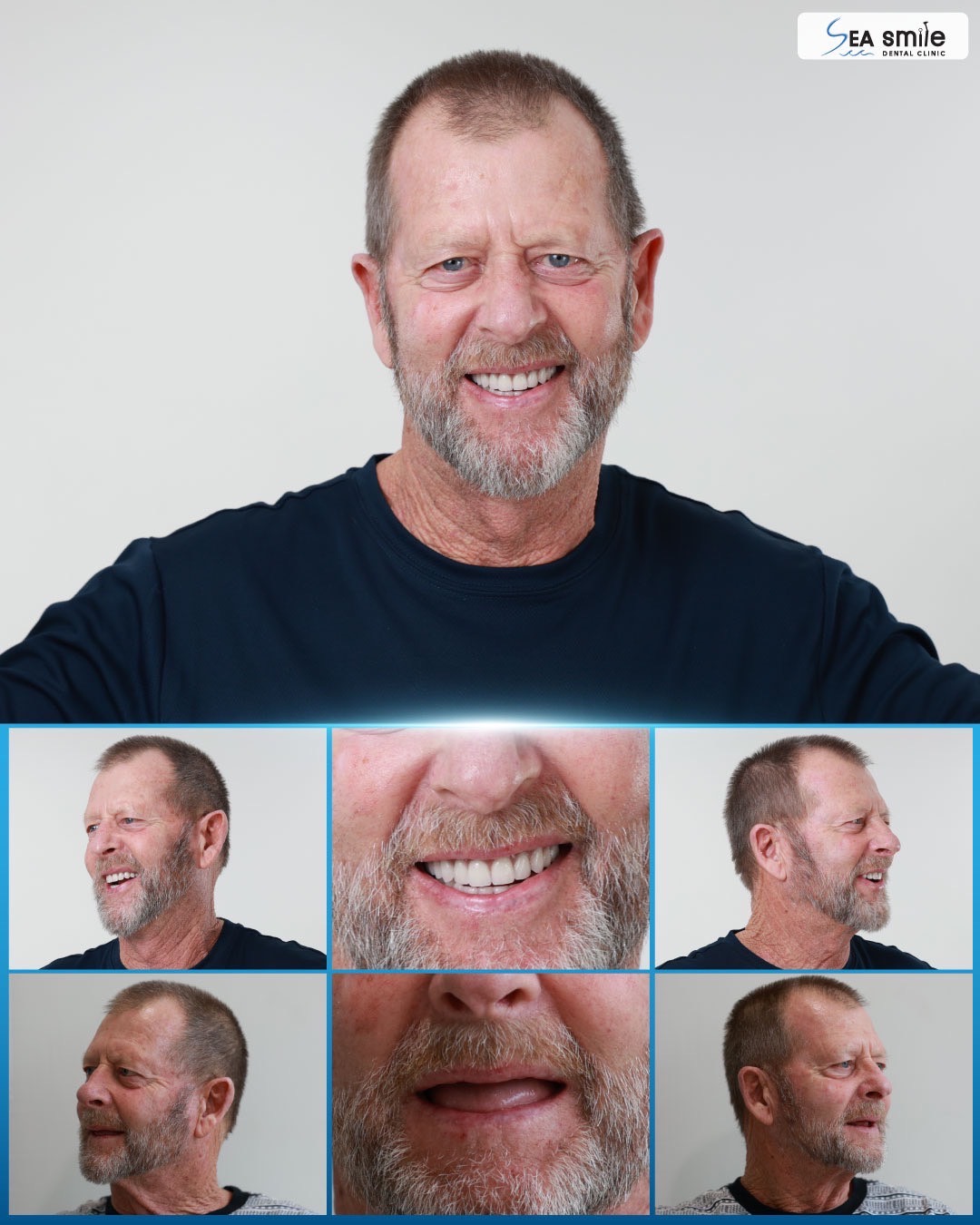 Our Patients All-On-4™