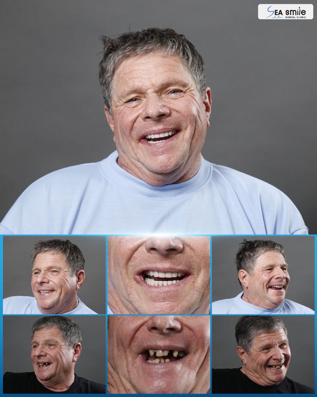 Our Patients All-On-4™
