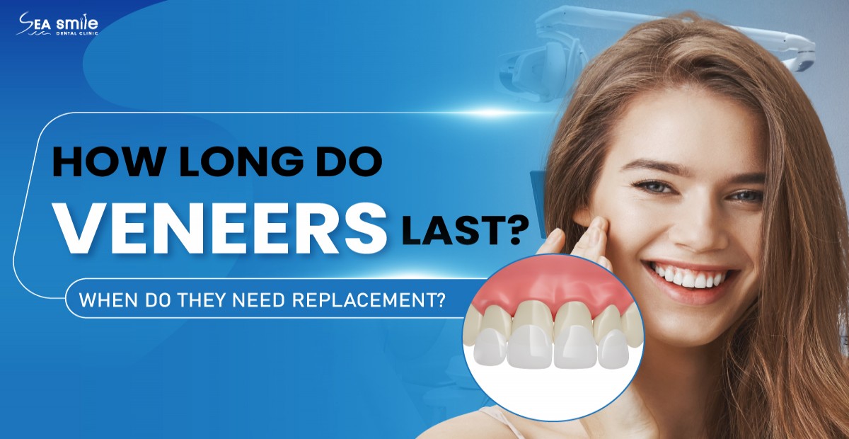 How Long Do Veneers Last? When Do They Need Replacement?
