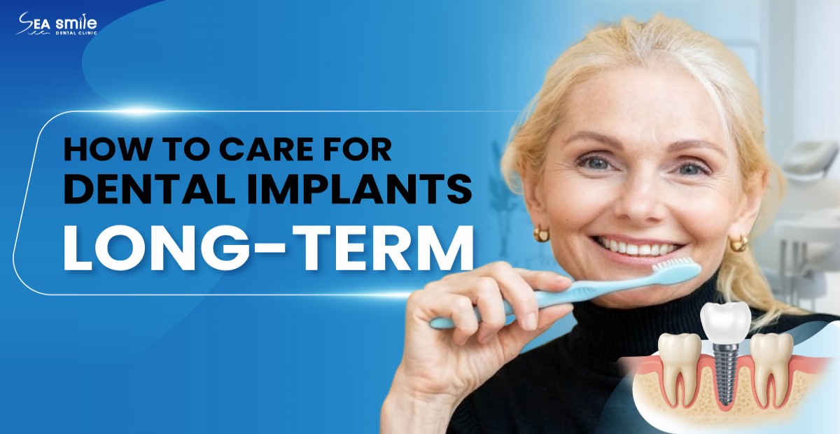 How to Care for Dental Implants Long-Term